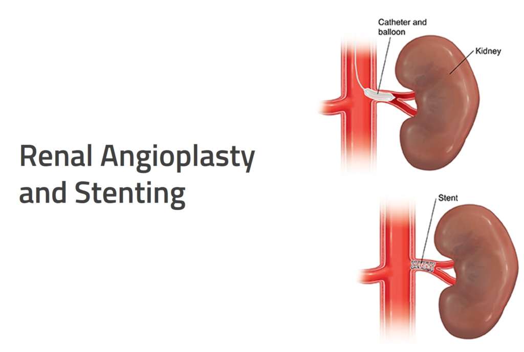 renal_angioplasty