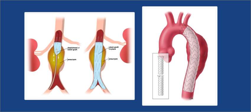 Evar Tevar For Aortic Dissection Aneurysm Ahmedabad