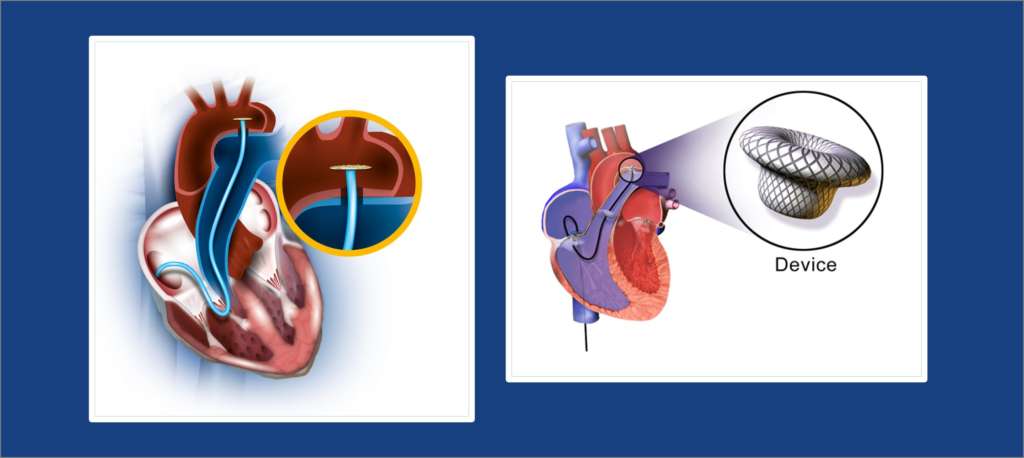 Device Closure of ASD, VSD and PDA | Ahmedabad | Dr. Subhash D. Chaudhari