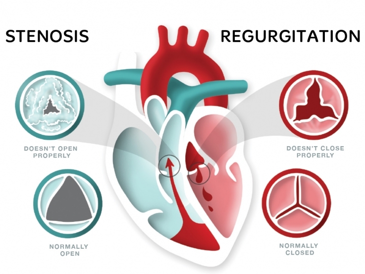 stenosis-regurgitation_737_553