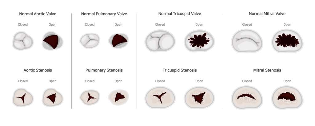 valve_disease_detail